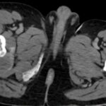 Condrosarcoma cadera - rescate con prótesis tumoral
