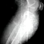 Osteosarcoma tibia