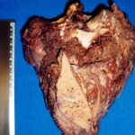 Condrosarcoma escápula