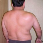 Condrosarcoma escápula