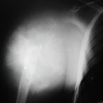 Osteosarcoma húmero proximal derecho