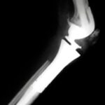 TCG de tibia con reconstrucción con prótesis tumoral