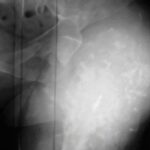 Osteocondromatosis múltiple