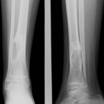Defecto fibroso tibial distal