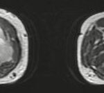 Sarcoma de partes blandas en pierna derecha