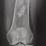 RX Condrosarcoma en fémur