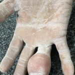 Tumor de células gigantes de la vaina tendinosa