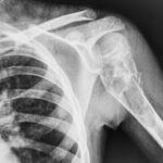 Quiste óseo fracturado húmero izquierdo