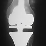 Osteosarcoma de tibia derecha - rescate con prótesis tumoral