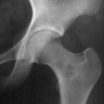 Fibroma en cadera