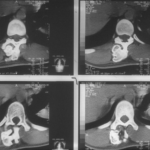 Osteocondroma en columna