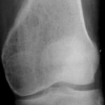 Tumor de células gigantes en fémur distal izquierdo