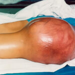 Osteosarcoma rodilla