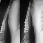 Reconstrucción con peroné vascularizado ipsilateral centralizado