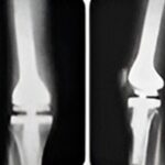 9.2 Condrosarcoma fémur distal - rescate con protesis tumoral