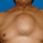 Condrosarcoma esternón