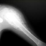 Osteosarcoma hombro