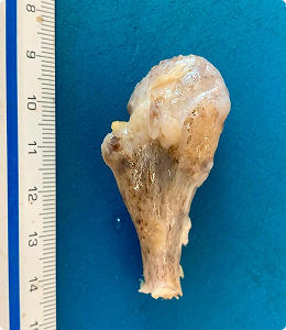Pieza quirúrgica de osteocondroma.