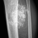 Seguimiento osteosarcoma de peroné con reconstrucción microvascularizada