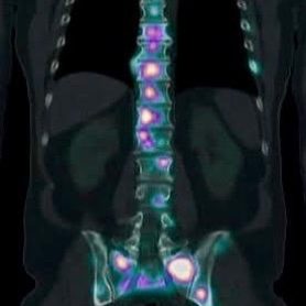 Metástasis en columna