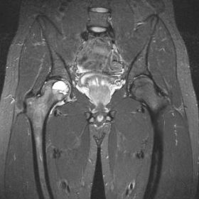 Resonancia con condroblastoma en fémur proximal derecho